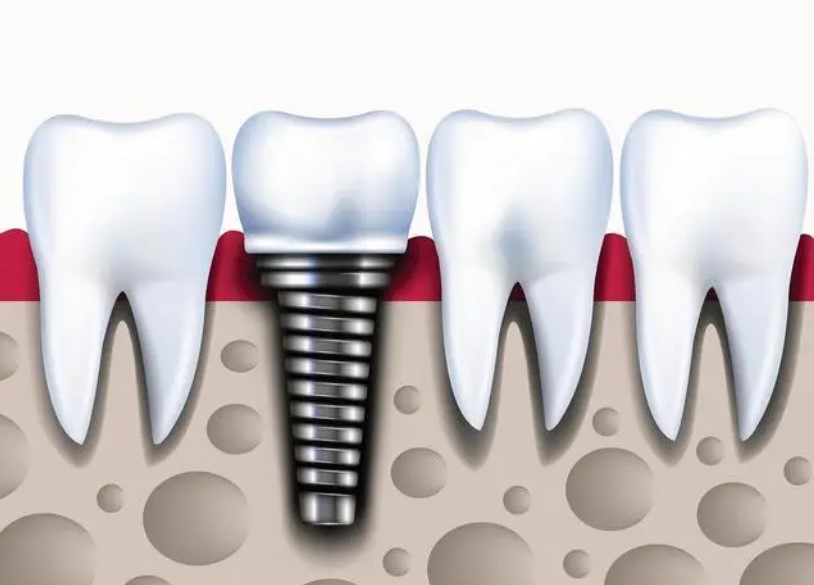 Shaped titanium wire for braces-1.jpg